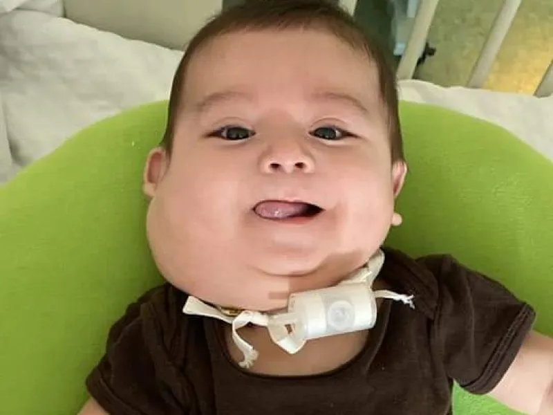 Padres desesperados por trasladar a su bebé de un año a Santiago e intervenir quirúrgicamente la linfagioma cervical