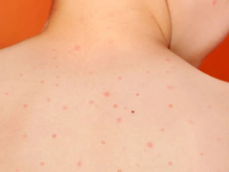 Piojos, verrugas y moluscos contagiosos: Cómo enfrentar a los intrusos del verano