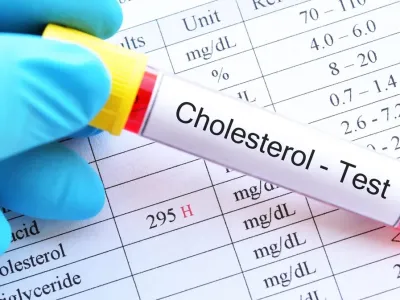 Colesterol: lo que dicen los exámenes más allá de un número