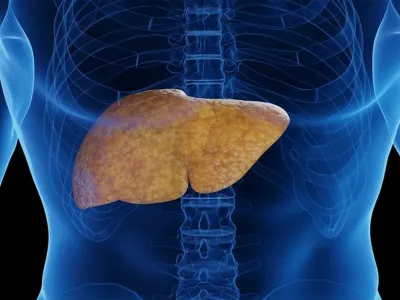 ¡Cuidado con el Hígado Graso! Puede poner en riesgo tu salud